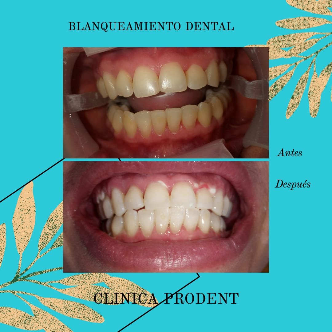 BLANCAMIENTO DENTAL